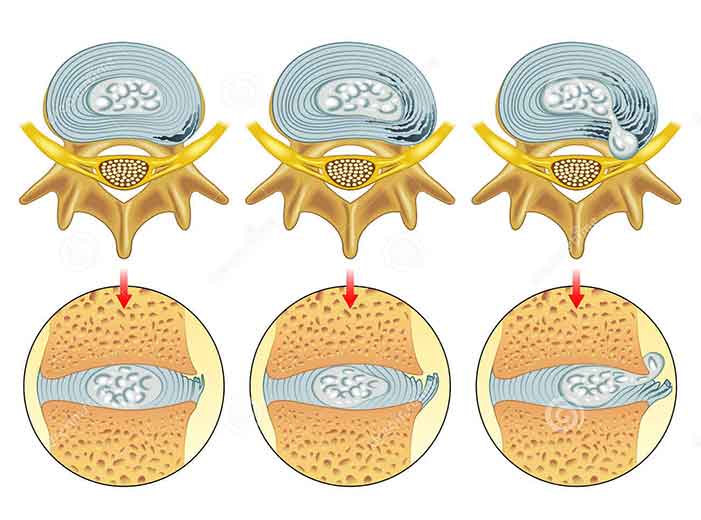 Chiropractic Richmond VA Disc with Annular Tears