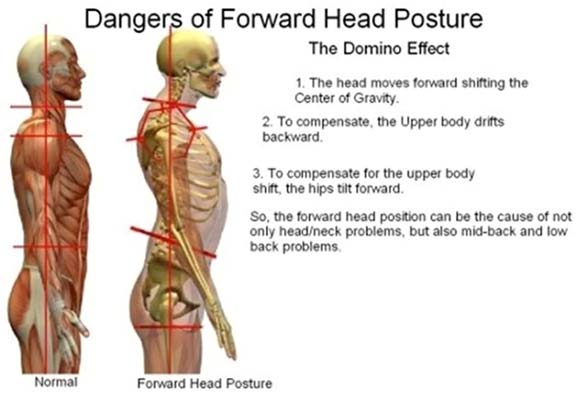 The Effects of Bad Posture - Merckling Family Chiropractic