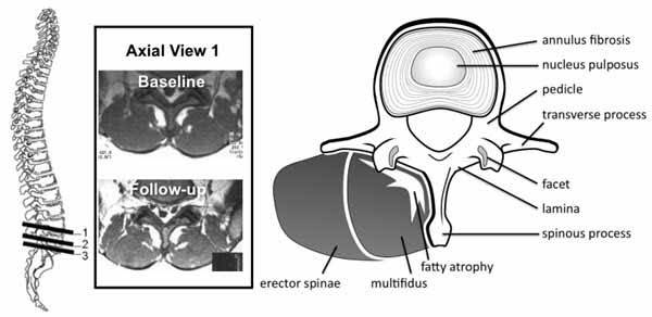 Chiropractic Richmond VA Multifidus Muscle Atrophy