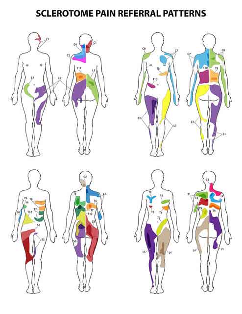 Visceral Referral Pattern Chart